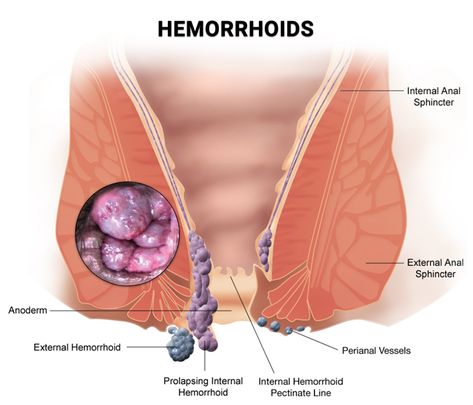 Discover if and when hemorrhoids go away on their own. Get insights on natural remedies and self-care for hemorrhoid relief. - #Canhemorrhoidshealnaturally #Canhemorrhoidsvanishnaturally #Canpilesresolvewithouttreatment #Canyoutreathemorrhoidswithoutintervention #Dohemorrhoidsdisappearontheirown #Dohemorrhoidshealbythemselves #Hemorrhoidself-care #Hemorrhoidself-healing... Hemorrhoid Remedies At Home, Hemorrhoid Relief Remedies, Hemroid Remedies How To Get Rid, Diy Hemorrhoid Relief Remedies, Hemorrhoid Remedies How To Get Rid Of, Hemroid Relief Fast, Hemmoroid Relief, External Hemmoroids, Piles Remedies