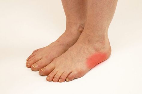 Cuboid syndrome can be one of the most misdiagnosed foot conditions - in part because many people have never even heard of it. Check out our latest blog article to learn what cuboid syndrome is, and how a chiropodist can help. #footpain #footcare #healthandwellness #torontofootclinic #feet #health #cuboidsyndrome #torontobloggers Cuboid Syndrome, Foot Pain Relief Remedies, Pain Relief Remedies, Foot Exercises, Foot Pain Relief, Trigger Points, Sports Medicine, Blog Article, Foot Pain