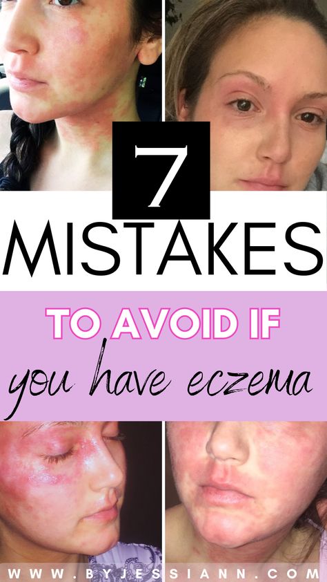 7 eczema triggers to avoid for clear skin - eczema remedies & excema relief tips Get Rid Of Excema, Excema Relief, Itchy Skin Remedy, Things To Stop Doing, Severe Dry Skin, Itching Skin, Treat Acne, Skin Remedies, Skin Skincare