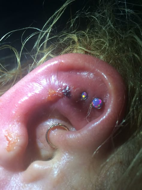 Unfortunate infection... Needed antibiotics and painkillers. Infected Piercing, Daith Piercing Infection, Infected Nose Piercing, Industrial Piercing Infected, The Last Of Us Infection Stages, Industrial Piercing Bump Remedy, Decay Art, Painkiller, Body Piercings