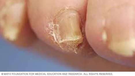 Slide show: How to trim thickened toenails - Mayo Clinic Nail Fungus Remedies, Thick Nails, Nail Fungus Remedy, Nail Infection, Fungal Nail, Ingrown Toe Nail, How To Get Thick, Nail Plate, Nail Fungus