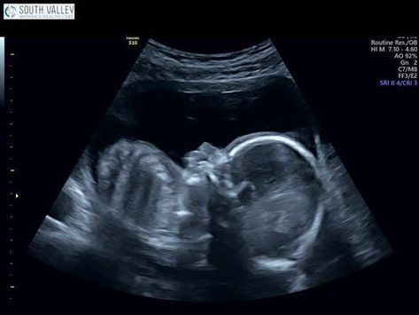 19 Week Ultrasound, Ultrasound Anatomy, 12 Weeks Pregnant Ultrasound, Scan Pictures, 3 Weeks Pregnant Ultrasound, Baby Ultrasound Pictures, 19 Weeks Pregnant Ultrasound, 8 Weeks Pregnant Ultrasound, 19 Weeks Pregnant