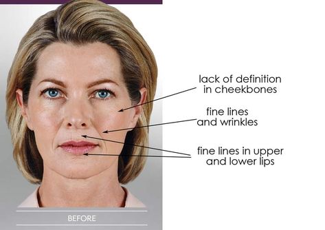 Your Guide to Juvederm Types: Voluma, Volbella & Vollure Juvederm Voluma, Laser Skin Care, Hyaluronic Acid Fillers, Human Tissue, Laser Skin, Dermal Fillers, Lip Fillers, Your Lips, Used Books