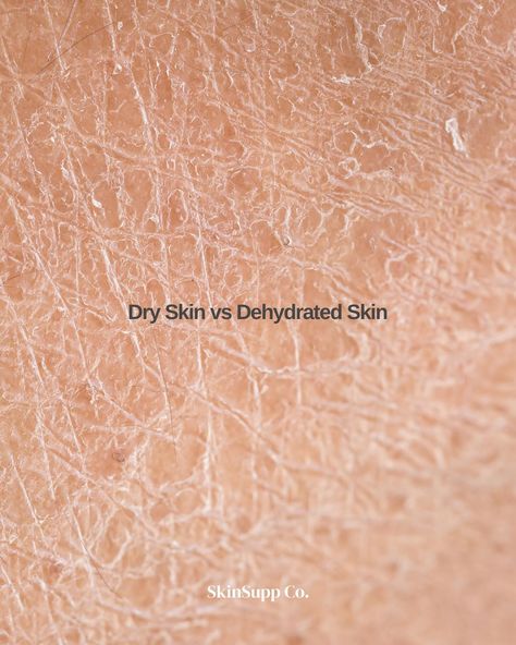 Understanding the difference between dry and dehydrated skin is key to choosing the right skincare products. 💧 #SkinSuppCo #ScienceBackedBeauty #skinsupp SkinCareTips Dry And Dehydrated Skin, Dehydrated Skin, Skin Treatments, Skincare Products, Aura, Repair, Key, Skin, Quick Saves