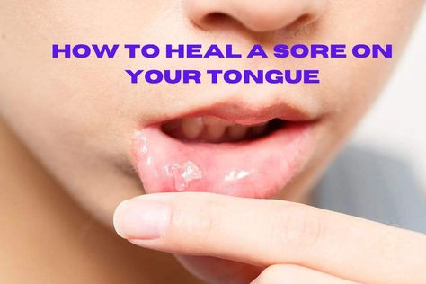 Sore on Your Tongue Cold Sore On Tongue, Sore On Tongue Remedy, Blister On Tongue, Bumps On Tongue, Ulcer On Tongue, Canker Sore Remedy, Tongue Sores, Pimples Remedies, Canker Sore