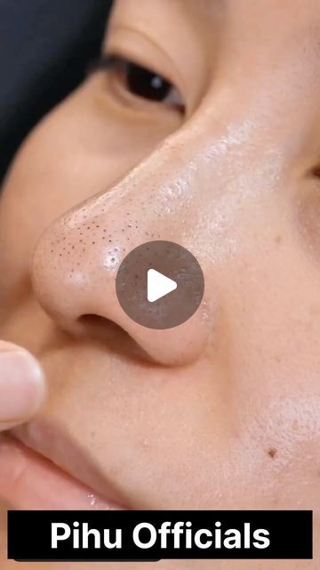 Pihu officials on Instagram: "Remove Blackheads Naturally At Home,Get Rid of Blackheads & Whiteheads 

.
.
.
.
.
#blackheads #whiteheads #blackheadsremoval #whiteheadsremoval #skincare #skincareriutine #trending" White Head Removal Video, Blackheads And Whiteheads Removal, How To Remove Whiteheads, Black Heads Removal Videos Youtube, Black Head Removal Video Nose, Huge Blackheads, Black Head Removal, Whiteheads Removal, Black Heads Removal Video