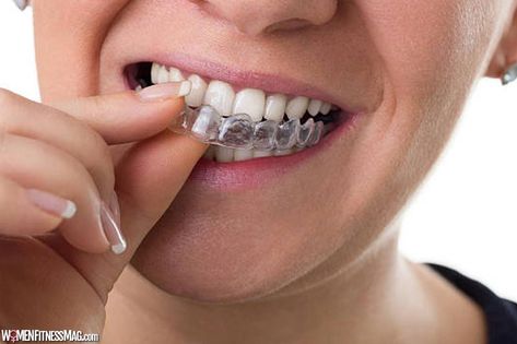 Women Fitness Magazine How to Achieve the Best Results from Teeth Aligners : Teeth aligners are one of the best and most convenient ways to deal with malocclusions. They can also help deal with things like gapped teeth or other structural issues. They do require that you use them correctly for them to work, however. The amount of […] The post How to Achieve the Best Results from Teeth Aligners appeared first on Women Fitness Magazine. Invisalign Braces, Teeth Alignment, Clear Braces, Teeth Straightening, Metal Braces, Dental Crowns, Smile Makeover, Family Dental, General Dentistry