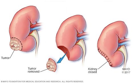 Nephrectomy (kidney removal) - Mayo Clinic Renal Cell Carcinoma, Tattoo Over Scar, Scar Tattoo, Med Surg, Types Of Cancers, Mayo Clinic, Body Organs, Surgery