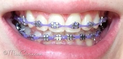 lilac/ lavender braces: power chain Lavender Braces, Chain Braces, Power Chain Braces, Dental Braces Colors, Braces Colors Combinations, Invisible Teeth Braces, Kawat Gigi, Power Chain, Natural Teeth Whitening Diy