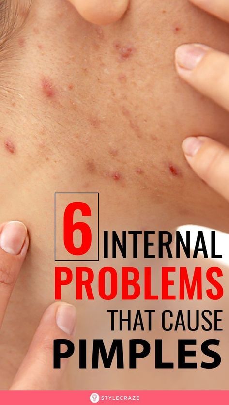 Cheek Pimples, What Causes Pimples, Cheek Acne, Painful Pimple, Pimple Causes, Blind Pimple, Prevent Pimples, Pimples Under The Skin, Acne Overnight