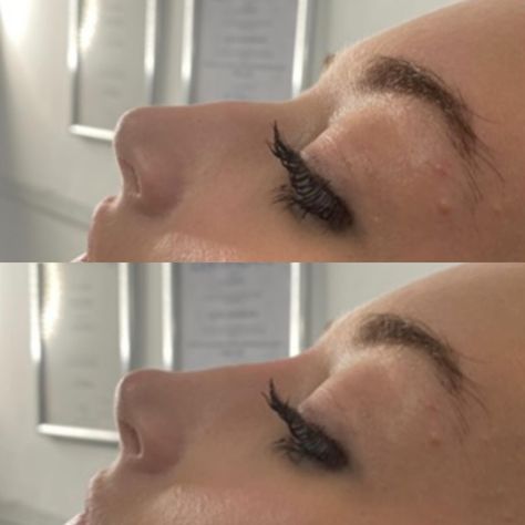 Transformation at its finest! ✨ Witness the incredible before and after results of a liquid rhinoplasty using dermal filler. Say goodbye to a bulky nose and hello to a smaller and straighter profile. 🙌✨ #RhinoplastyMagic #BeforeAndAfter #ConfidenceBoost #nosejob #nosejobuk #nosejobessex #nosejobbenfleet #rhinoplasty #rhinoplastyuk #rhinoplastyessex #rhinoplastybenfleet #liquidrhinoplasty #liquidrhinoplastyuk #liquidrhinoplastyessex #liquidrhinoplastybenfleet #nonsurgicalnosejob #nonsurgical... Liquid Rhinoplasty Before And After, Nose Filler Before After, Liquid Rhinoplasty, Nonsurgical Nose Job, Nose Fillers, Rhinoplasty Before And After, Nose Job, Dermal Fillers, Confidence Boost