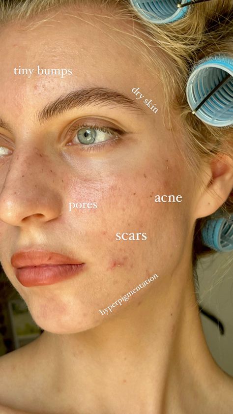 People With Acne Pretty, Beautiful Girls With Acne, Imperfect Skin Aesthetic, Clean Girl With Acne, Pretty Acne Aesthetic, Acne Skin Aesthetic, Acne Aesthetic Girl, Acne Girls Pretty, Romanticizing Acne