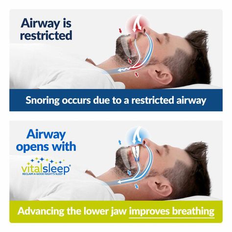 Get a great night's sleep without snoring with the VitalSleep snoring mouthpiece. This device for snoring comes with a 60-night money-back guarantee to guaranteed a better night's sleep. Sleep Number Bed, Prediabetic Diet, Snoring Remedies, Snoring Solutions, Sleep Products, How To Stop Snoring, Stop Snoring, Anti Snoring, Skin Care Wrinkles