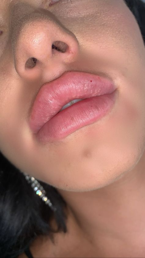 Lips Injections Shapes, Cut On Lip, Lip Injections Shapes, Lip Fillers Shapes, Natural Lip Fillers, Lip Filler Aesthetic, Desired Lips, Lip Filler Inspiration, Latina Aesthetic Hair