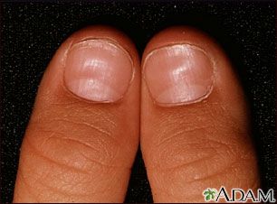 Koilonychia Split Toenail, Fingernail Health, Pink Toe Nails, Fingernail Fungus, Nail Conditions, Nail Problems, Pink Toes, Iron Deficiency, Nutrient Deficiency