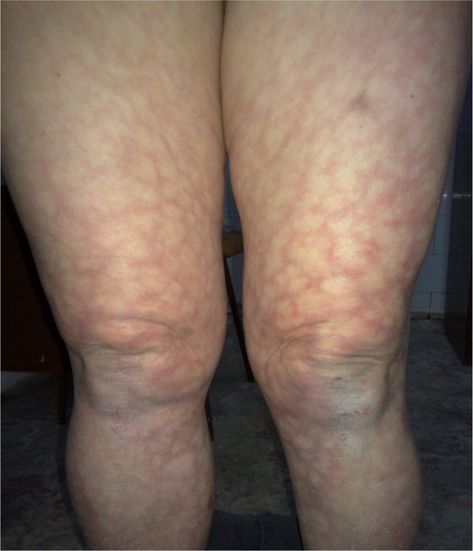 Reddish-Violet, Reticular Discoloration on the Legs Livedo Reticularis, Radiation Exposure, Skin Diseases, Autoimmune Disease, Dermatology, Skin, Health