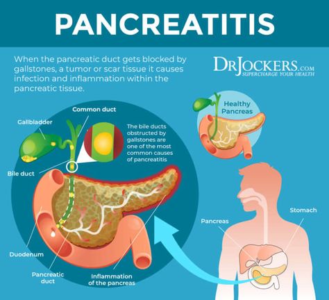 Pancreatitis: Symptoms, Causes and Natural Support Strategies Pancreatic Diet, Pancreatic Diet Recipes, Pancreas Health, Healthy Liver Diet, Healing Naturally, Low Stomach Acid, Liver Diet, Biology Facts, Med Surg