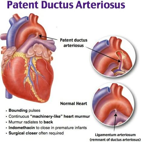 Cath Lab Nursing, Respiratory Therapist Student, Patent Ductus Arteriosus, Cardiac Sonography, Medical Terminology Study, Nurse Teaching, Nursing School Essential, Heart Diseases, Surgical Nursing