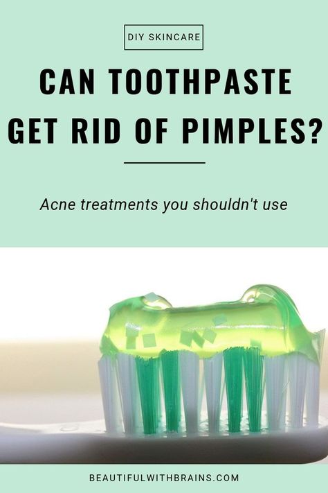 Does toothpaste help pimples?It’s a legit question. When I was 15, I read in a magazine (hey, we didn’t have the internet back then!) that putting toothpaste on pimples would get rid of them. You know what: it worked. But that doesn’t mean you should do it. Click pin to find out what really happens when you put toothpaste on pimples #breakouts #DIYskincare Dry Out Pimples, Get Rid Of Pimples, Rid Of Pimples, Skincare Acne, Prevent Pimples, Diy Hack, Types Of Acne, How To Get Rid Of Pimples, Hygiene Routine