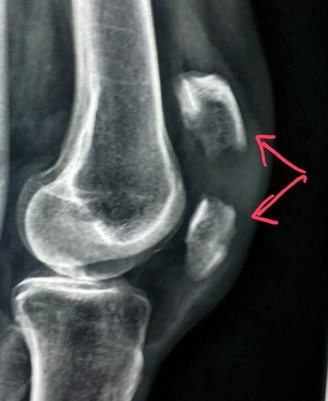 #Knee xray shows a #fracture through the #kneecap (#patella) in a #patient who #fell.  #radiology #radiologist #pain #injury Knee Xray, Knee Cap, Radiology, X Ray