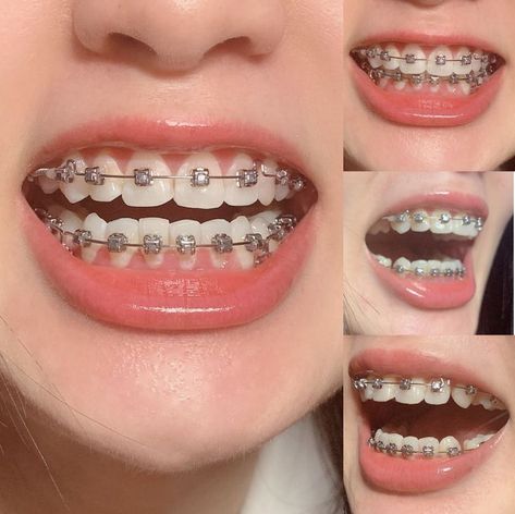 Brackets Aesthetic, Braces Aesthetic, Fixed Braces, Kawat Gigi, Teeth Aesthetic, Cute Braces Colors, Braces Tips, Getting Braces, Braces Girls