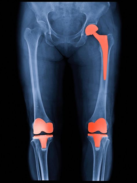 Are you finding best Knee Replacement Surgeon East Delhi, Hip Replacement Surgeon East Delhi? Dr Prof Anil Arora is the best Joint replacement surgeon Delhi, India. Hip Strengthening Exercises, Bursitis Hip, Piriformis Syndrome, Knee Replacement Surgery, Knee Surgery, Knee Replacement, Therapeutic Massage, Hip Pain, Surgery