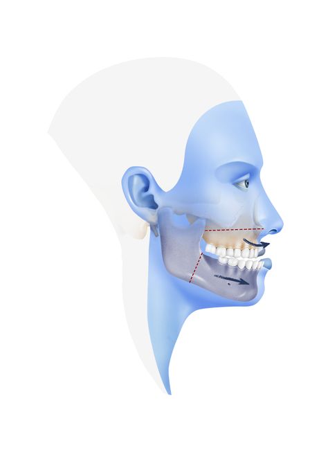 Orthognathic Surgery, Character Animation, Animated Characters, Surgery, Eye Makeup, Facial, Medical, Disney Characters, Makeup