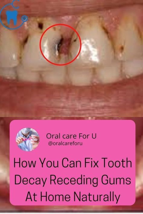 Grow Back Receding Gums, Fix Teeth, Tooth Decay Remedies, Dental Cavities, Tooth Sensitivity, Teeth Health, Oral Care Routine, Receding Gums, Gum Care