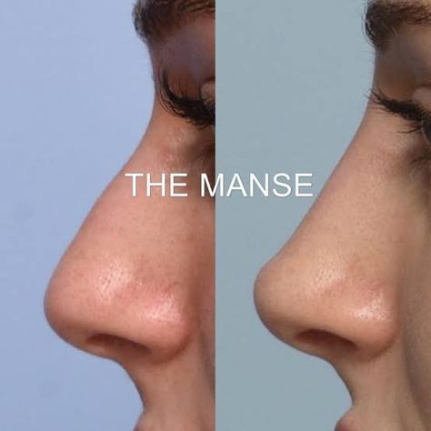 Non Surgical Rhinoplasty, Nose Filler, Face Plastic Surgery, Nose Surgery Rhinoplasty, Nose Fillers, Upturned Nose, Parts Of The Nose, Nose Types, Rhinoplasty Nose Jobs