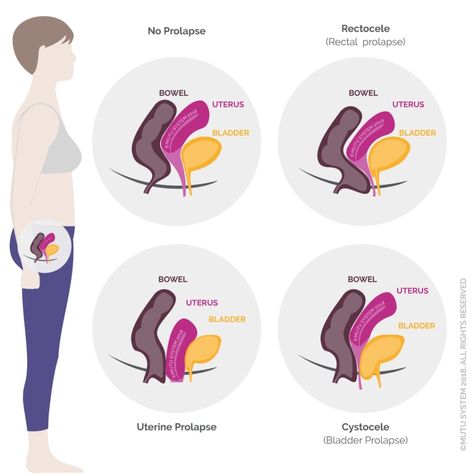 Understanding pelvic organ prolapse (and why kegels aren't enough) Prolapse Exercises, Bladder Prolapse, Pelvic Floor Muscle Exercise, Rectal Prolapse, Uterine Prolapse, Pelvic Floor Therapy, Pelvic Organ Prolapse, Improve Nutrition, Pelvic Floor Exercises