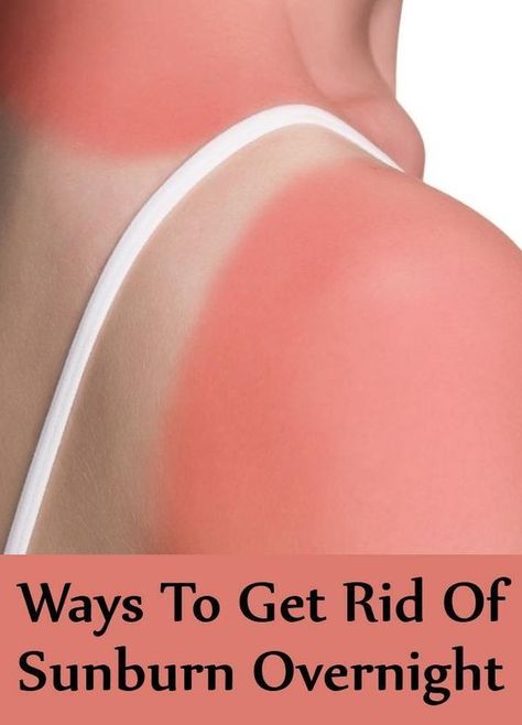 Remedies For Sunburn, Home Remedies For Sunburn, Get Rid Of Sunburn, Natural Remedies For Sunburn, Sunburn Skin, Sunburn Remedies, Sunburn Relief, Skin Natural Remedies, Lighter Skin