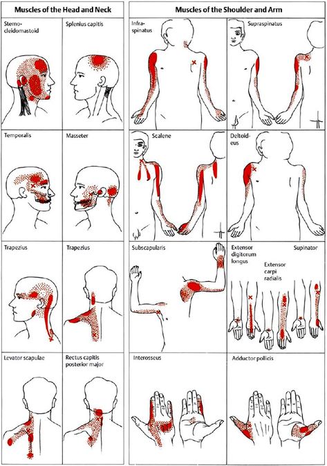 Examples of trigger points and referred pain in the reference sites (pain reference pattern; after Travell and Simons, 1983a). Myofascial Trigger Points and Pain Referral Patterns  Referred pain, in the presence of either an active or a latent MTrP, is usually very well-localized.  MTrP in the sternal region of the sternocleidomastoid muscle can cause satellite MTrPs in the sternalis muscle, pectoralis muscle, and the serratus anterior major muscle. MTrPs can be found in any skeletal muscle Trigger Point Referral Patterns, Muscle Trigger Points, Punkty Spustowe, Serratus Anterior, Night Moth, Sternocleidomastoid Muscle, Myofascial Pain Syndrome, Referred Pain, Basic Anatomy And Physiology