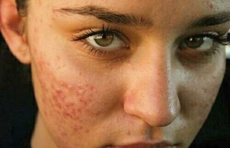 Why Acne Doesn’t Make You Any Less Beautiful