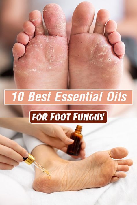 Want to ditch conventional foot fungal treatments for natural remedies? This article about Essential Oils for Foot Fungus is only for you! Natural Remedies For Toenail Fungus, Foot Fungus Remedies How To Get Rid Of, Essential Oils For Feet Dry Skin, Natural Athletes Foot Remedy, Essential Oil For Athletes Foot, Natural Remedies For Athletes Foot, Natural Antifungal Remedies For Skin, Anti Fungal Remedies For Skin, Toe Nail Fungus Home Remedy