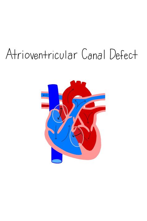 Nursing School Notes - Atrioventricular Canal Defect (holes between the atriums and ventricles), congenital heart condition / disease, pathophysiology, pediatric heart condition Pediatric Surgery, Congenital Heart, College Advice, Nursing School Notes, Heart Conditions, Cardiovascular System, Medical Knowledge, School Notes, Nursing School