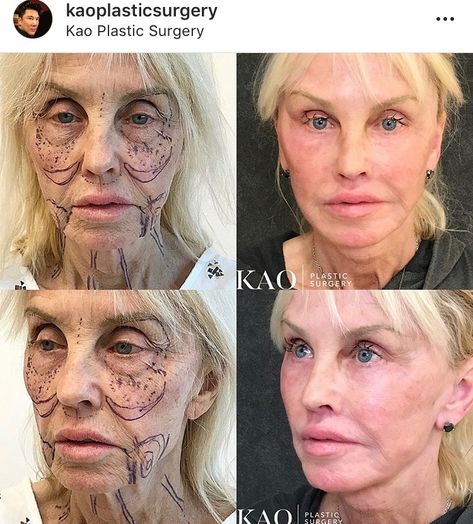 Ponytail Lift, Cheek Lift, Facial Procedure, Plastic Surgery Gone Wrong, Fat Transfer, Force Of Nature, Neck Lift, Facial Rejuvenation, Brow Lift