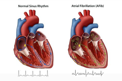 Afib Atrial Fibrillation, Valsalva Maneuver, Normal Sinus Rhythm, Good Blood Pressure, Low Magnesium, Belly Breathing, Atrial Fibrillation, Heart Rhythms, Health Ideas