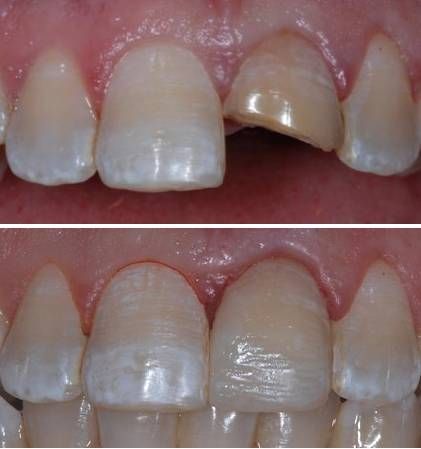 Direct Restorations: Class IV composite. Using a prototype ... Dental Composite Restoration, Dental Composite, University Of Birmingham, Dental Implants, Dental Clinic, Dental Care, Birmingham, Composition, University