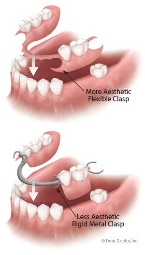 Types of flexible partial dentures. Dental Assistant Study, Dental Images, Kedokteran Gigi, Dental Anatomy, Partial Dentures, Dental Facts, Tooth Replacement, Teeth Implants, Dental Bridge