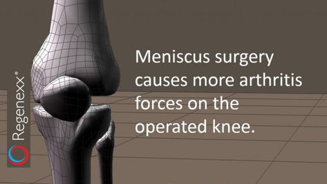 Meniscus Surgery Arthritis: Removing a Small Amount of Meniscus Causes Problems Meniscus Surgery, Ligament Tear, Knee Surgery, Stem Cells, What Happens When You, Surgery, Health