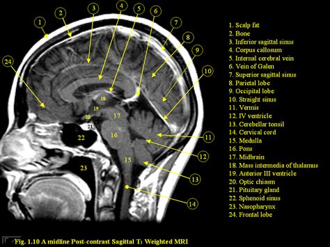 Ct Scan Brain Anatomy, Anatomy Of Brain, Ct Anatomy, Ct Brain, Brain Mri, Brain Scans, Mri Brain, Radiology Student, Occipital Lobe