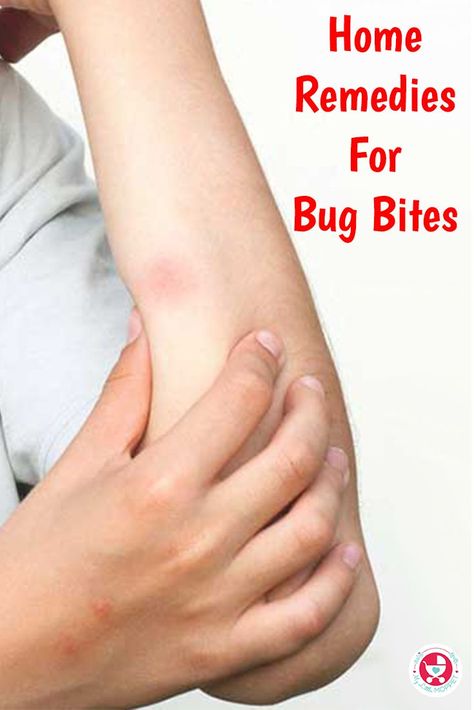 Remedies For Bug Bites, Bug Bite Itch, Itchy Bug Bites, Bug Bites Remedies, Ancient Remedies, Bug Repellant, Bug Bite, Common Knowledge, Kitchen Herbs