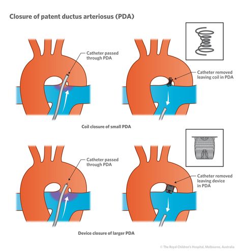 Patent Ductus Arteriosus, Neonatal Nurse Practitioner, Nclex Review, Congenital Heart Defect, Neonatal Nurse, Heart Defect, Congenital Heart, Respiratory Therapy, Rad Tech