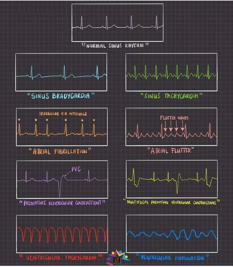 Vital Signs Chart, Ekg Leads, Graphic Score, Nurse Skills, Ekg Interpretation, Normal Sinus Rhythm, Nursing School Survival, Research Images, Atrial Fibrillation