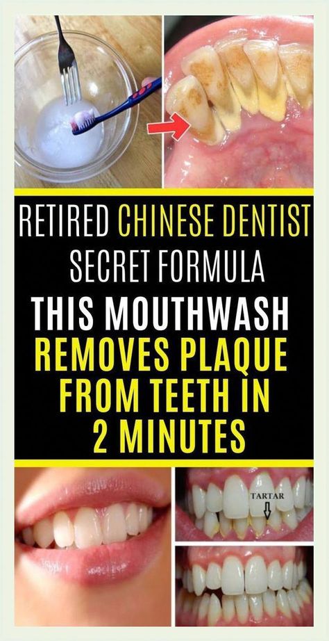 Remove Plaque From Your Teeth Just In 2 Minutes! Remove Plaque From Teeth, Teeth Decay, Heal Cavities, Dental Implants Cost, Teeth Implants, Health Heal, Oral Care Routine, Receding Gums, Oral Health Care