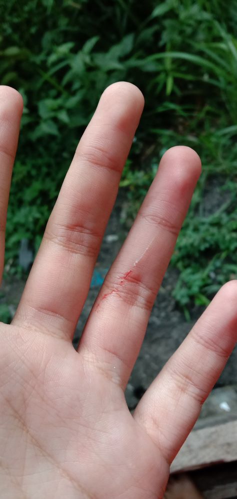 Pap Tangan Di Iris Kaca, Hand Hurt Fake Story, Injury Fake Story, Toreh Tangan, Fake Sick, 2000 Wallpaper, Radha Beauty, Hospital Admit Hand Pics, Hospital Photography