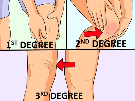 Mcl Injury Recovery, Mcl Sprain Recovery, Mcl Strain Knee Exercises, Knee Sprain Recovery, Ligaments Of The Knee, Torn Ligament In Knee, Knee Sprain, Knee Injury Recovery, Neck Sprain