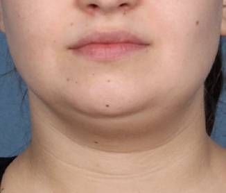 Case 100177 - Before and After Kybella Photos Kybella Before And After, Facial Plastic Surgery, Guest Hair, Brow Lift, Cool Sculpting, Facial Plastic, Anti Aging Beauty, Cosmetic Procedures, Makeup Makeover