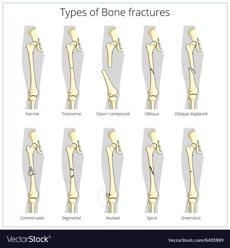 Medical Skeleton, Stitches Medical, Types Of Fractures, Types Of Bones, Radiology Technician, Skeleton Anatomy, Bone Fracture, Basic Anatomy And Physiology, Vet Medicine