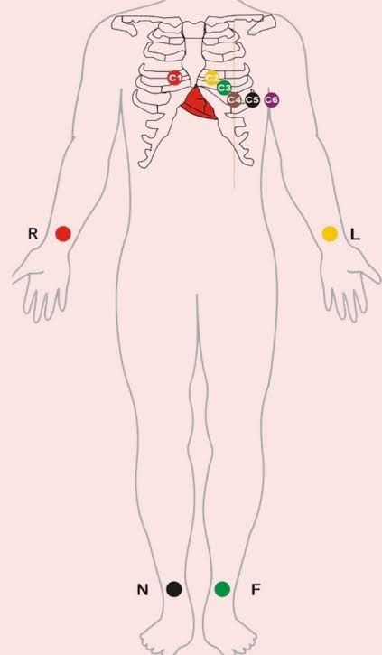 ECG Leads placement Ecg Lead Placement, Echocardiography Study, Ekg Lead Placement, 12 Lead Ekg Placement, Ecg Placement, Ekg Placement, Phlebotomy School, Ekg Leads, Emt Study